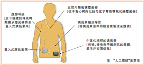 闭环胰岛素泵为什么更贵