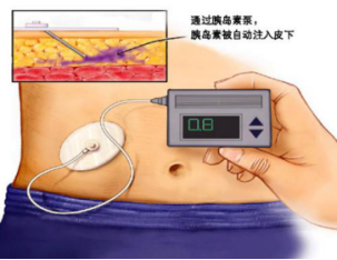 胰岛素泵使用期间要规避那些错误