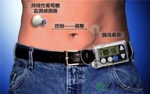 胰岛素泵使用效果丨稳糖北京客户服务中心实例对比