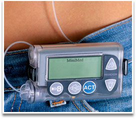 使用胰岛素泵治疗糖尿病有哪些优点