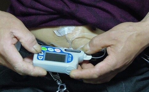 关于胰岛素泵治疗糖尿病的临床疗效病例
