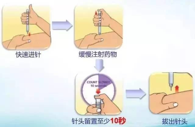 孕妇胰岛素注射部位图图片